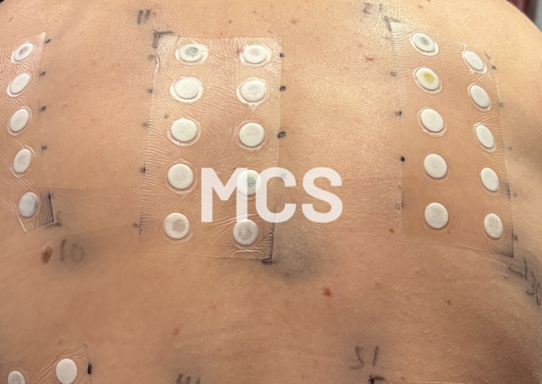 MCS - Multiple Chemikalien Sensitivität